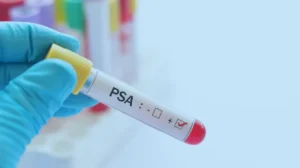 Exames PSA total e livre - exames definitivos para auxiliar o diagnóstico do câncer de próstata