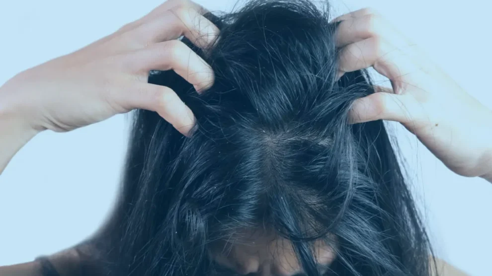 Doenças dermatológicas do couro cabeludo: conheça as principais