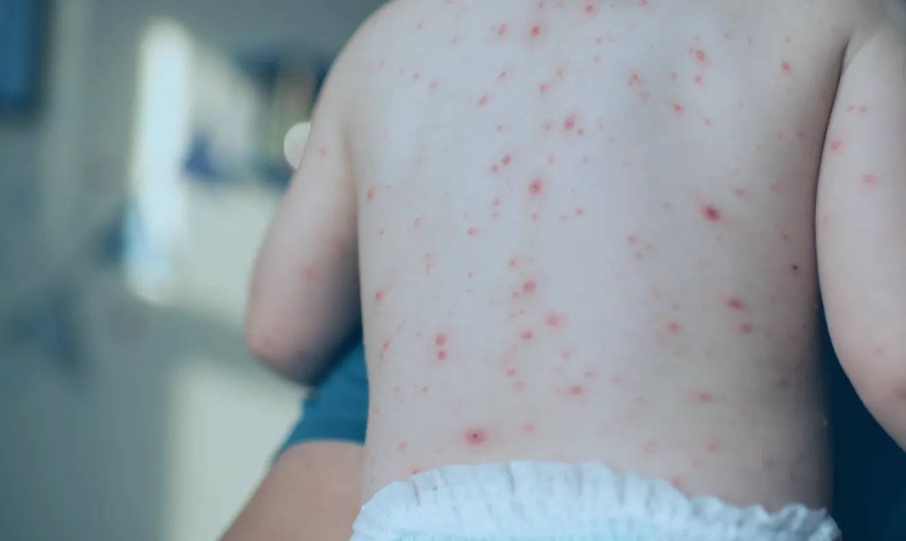 MPOX e Catapora: veja as principais diferenças