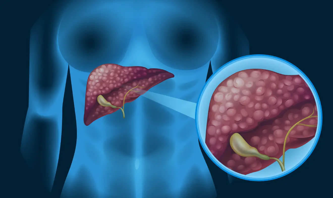 Adenomas: tipos, diagnóstico e tratamento explicados de forma clara