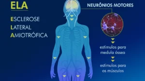 ELA-Esclerose Lateral Amiotrofica