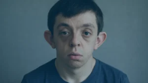 Sindrome-de-Noonan-uma-doenca-genetica-que-afeta-multiplas-partes-do-corpo