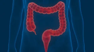 Colite ulcerosa: Principais características e exames diagnósticos